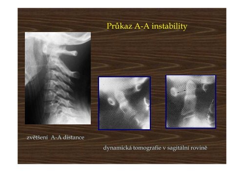 Trauma of the cervical spine - AKUTNE.CZ