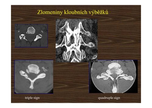 Trauma of the cervical spine - AKUTNE.CZ