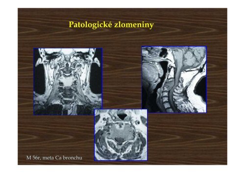 Trauma of the cervical spine - AKUTNE.CZ