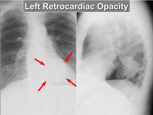 Basic CXR Interpretation - EthnoMed