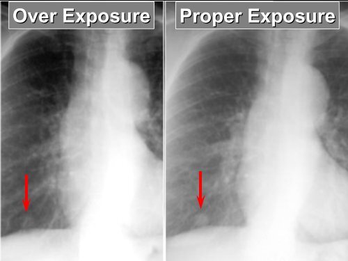 Basic CXR Interpretation - EthnoMed