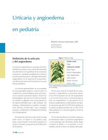 Urticaria y angioedema en pediatrÃ­a