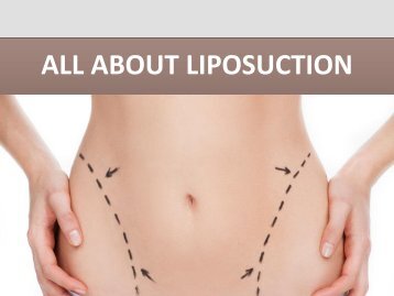 Liposuction in Baltimore – Feel great!