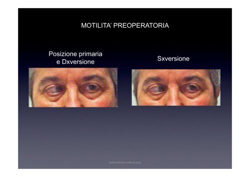 Paralisi (iatrogena?) del VI nervo cranico