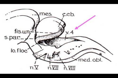 A Cerebellomedullary Fissure Approach to Fourth Ventricle Tumors