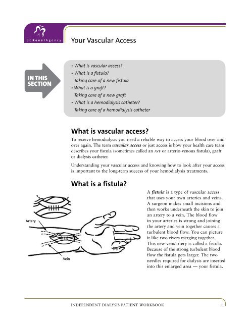 What is vascular access? What is a fistula? Your ... - BC Renal Agency