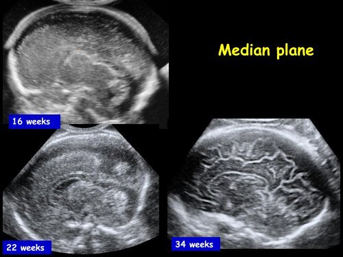 3D Fetal Neurosonography