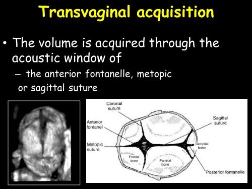3D Fetal Neurosonography