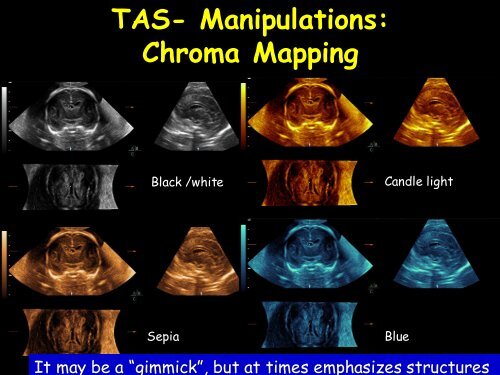 3D Fetal Neurosonography