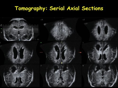 3D Fetal Neurosonography