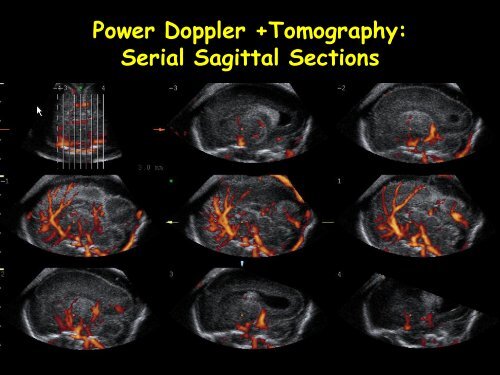 3D Fetal Neurosonography