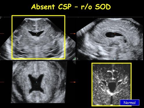 3D Fetal Neurosonography