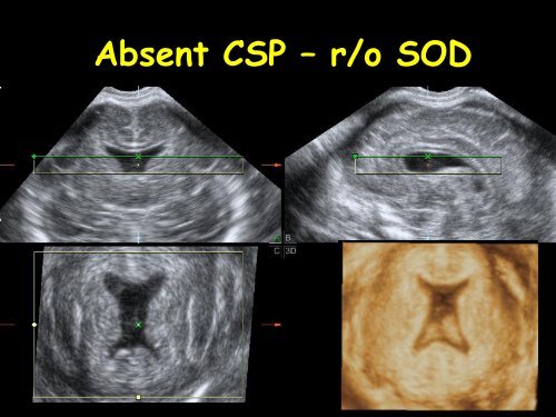 3D Fetal Neurosonography