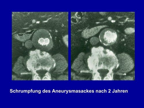 Aorten-Bifurkationsprothese