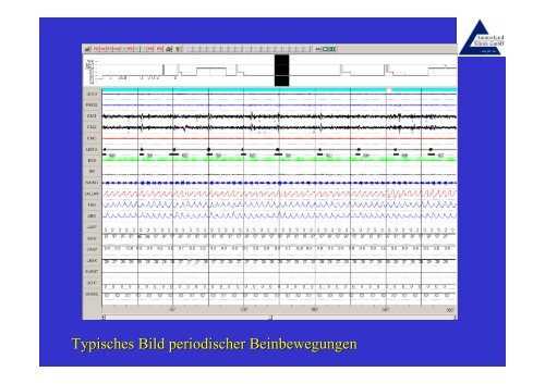 Schlafbezogene rhythmische BewegungsstÃ¶rung