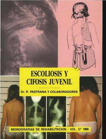 ESCOLIOSIS y CIFOSIS JUVENIL