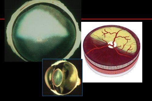 complications of phaco