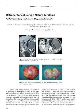 Retroperitoneal Benign Mature Teratoma - InaActaMedica.org