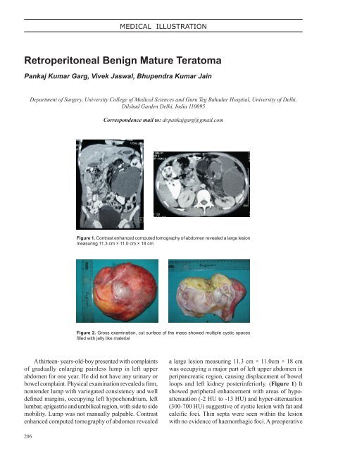 Retroperitoneal Benign Mature Teratoma - InaActaMedica.org