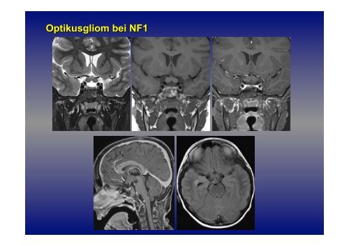 Prof. Dr. med. Gerhard Schuierer Zentrale Neuropathien!