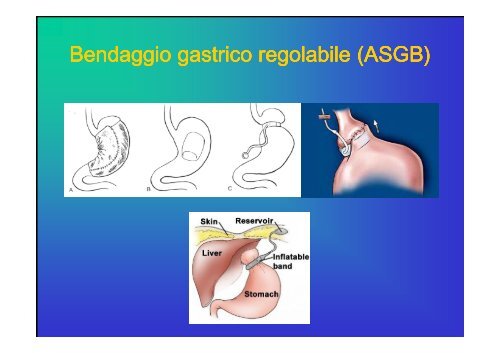 Indicazioni e risultati della chirurgia bariatrica - Cattedra Chirurgia ...