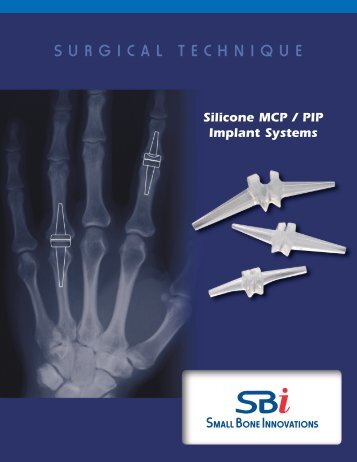 1 - Small Bone Innovations