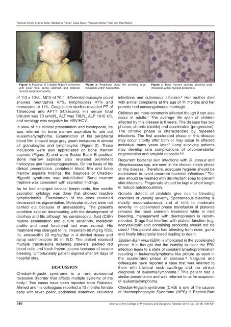 Chediak-Higashi Syndrome Presenting in Accelerated Phase