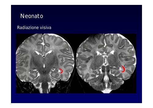 Neuroimaging nei bambini con deficit visivo centrale Neuroimaging ...