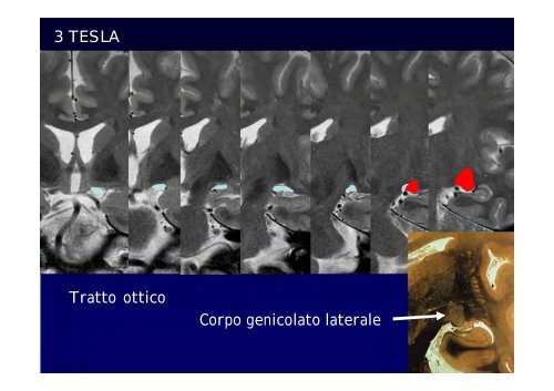 Neuroimaging nei bambini con deficit visivo centrale Neuroimaging ...