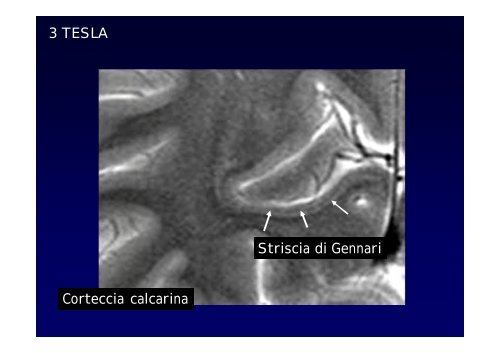 Neuroimaging nei bambini con deficit visivo centrale Neuroimaging ...