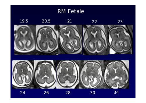 Neuroimaging nei bambini con deficit visivo centrale Neuroimaging ...