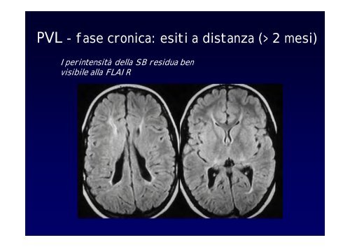 Neuroimaging nei bambini con deficit visivo centrale Neuroimaging ...