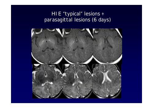 Neuroimaging nei bambini con deficit visivo centrale Neuroimaging ...