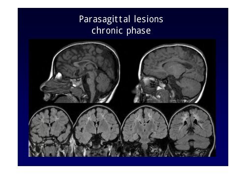 Neuroimaging nei bambini con deficit visivo centrale Neuroimaging ...