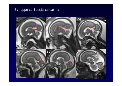 Neuroimaging nei bambini con deficit visivo centrale Neuroimaging ...