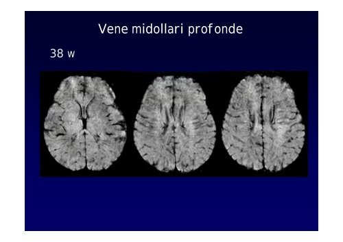 Neuroimaging nei bambini con deficit visivo centrale Neuroimaging ...