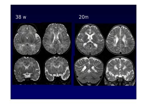 Neuroimaging nei bambini con deficit visivo centrale Neuroimaging ...