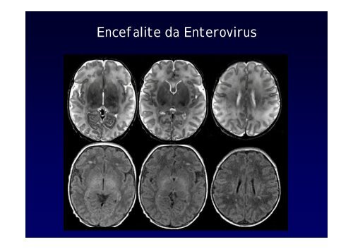 Neuroimaging nei bambini con deficit visivo centrale Neuroimaging ...