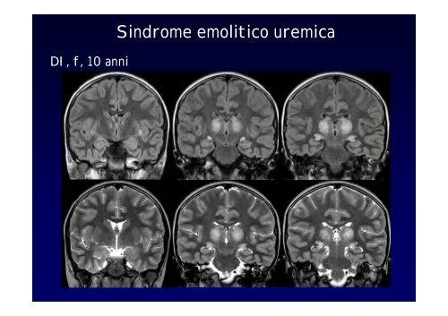 Neuroimaging nei bambini con deficit visivo centrale Neuroimaging ...