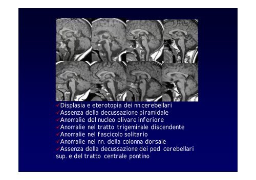 Neuroimaging nei bambini con deficit visivo centrale Neuroimaging ...