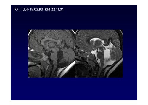 Neuroimaging nei bambini con deficit visivo centrale Neuroimaging ...