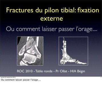 Fixateur externe & fractures du pilon tibial - ClubOrtho.fr