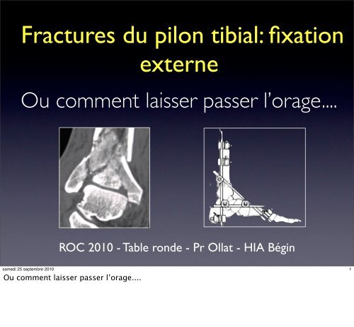 Fixateur externe & fractures du pilon tibial - ClubOrtho.fr