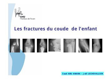 Les fractures du coude de l'enfant - CHU de Rouen