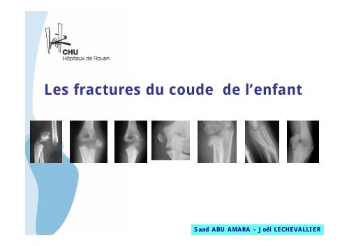 Les fractures du coude de l'enfant - CHU de Rouen