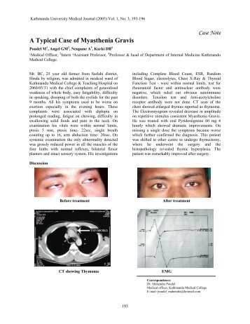 A Typical Case of Myasthenia Gravis - Kathmandu University ...