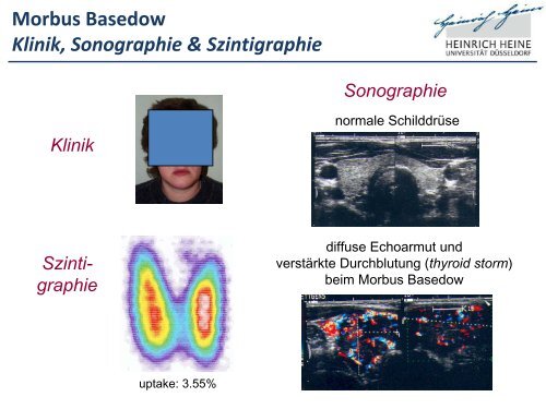 AntikÃ¶rperdiagnostik bei autoimmunen SchilddrÃ¼senerkrankungen