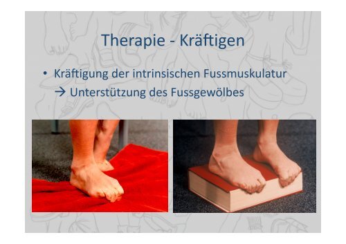 Fasziitis plantaris – mehr als ein Fersensporn - LUKS