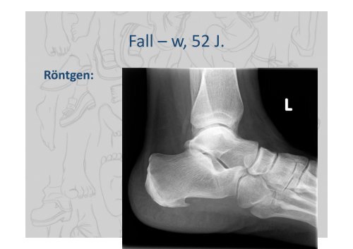 Fasziitis plantaris – mehr als ein Fersensporn - LUKS