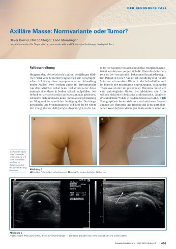 Axilläre Masse: Normvariante oder Tumor? - Swiss Medical Forum